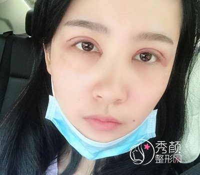 上海华美杨亚益割双眼皮开眼角恢复过程,7mm扇形真的很适合我!