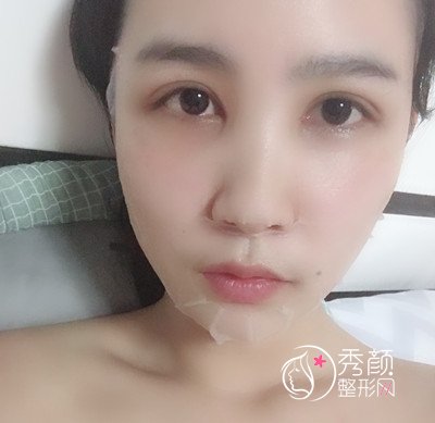 上海华美杨亚益割双眼皮开眼角恢复过程,7mm扇形真的很适合我!