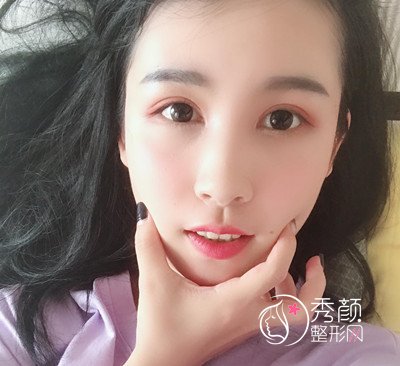 上海华美杨亚益割双眼皮开眼角恢复过程,7mm扇形真的很适合我!