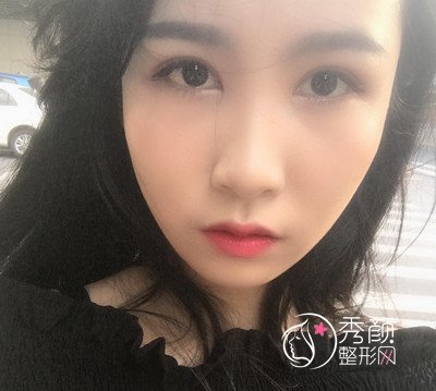 上海华美杨亚益割双眼皮开眼角恢复过程,7mm扇形真的很适合我!