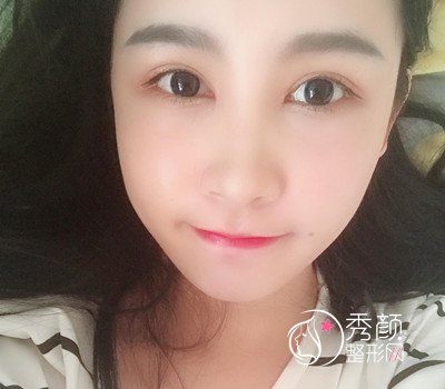 上海华美杨亚益割双眼皮开眼角恢复过程,7mm扇形真的很适合我!