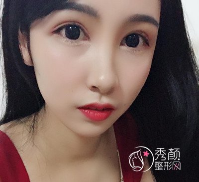 上海华美杨亚益割双眼皮开眼角恢复过程,7mm扇形真的很适合我!
