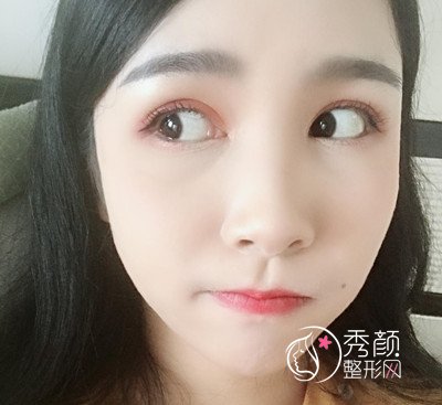 上海华美杨亚益割双眼皮开眼角恢复过程,7mm扇形真的很适合我!