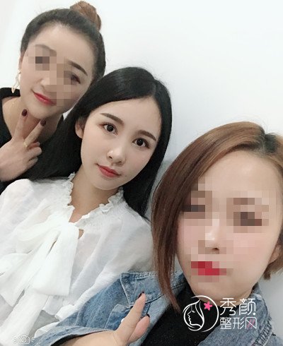 上海华美杨亚益割双眼皮开眼角恢复过程,7mm扇形真的很适合我!