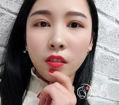 上海华美杨亚益割双眼皮开眼角恢复过程,7mm扇形真的很适合我!