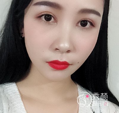 上海华美杨亚益割双眼皮开眼角恢复过程,7mm扇形真的很适合我!