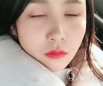 上海华美杨亚益割双眼皮开眼角恢复过程,7mm扇形真的很适合我!