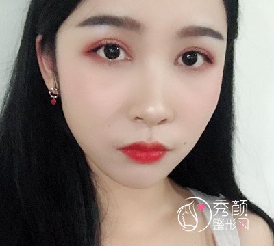 上海华美杨亚益割双眼皮开眼角恢复过程,7mm扇形真的很适合我!