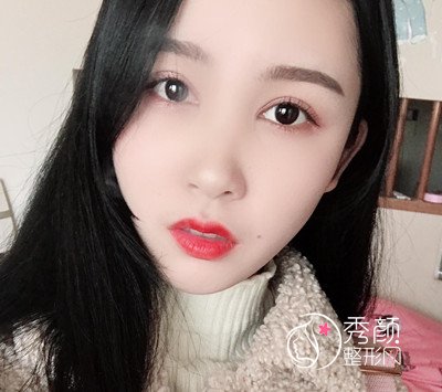 上海华美杨亚益割双眼皮开眼角恢复过程,7mm扇形真的很适合我!