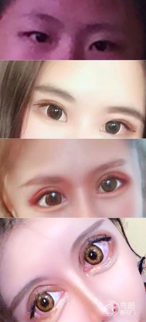 女网红全脸整容,花费400万整容失败却不自知,怒怼黑粉