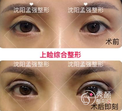 沈阳腾采整形孟强医生双眼皮修复怎么样,贵不贵?