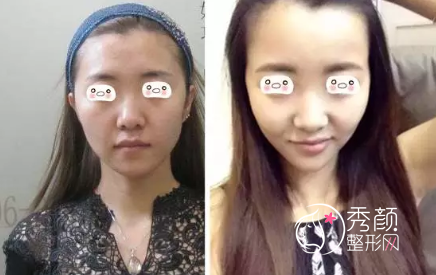 为什么越来越多明星、网红都在做面部脂肪填充?