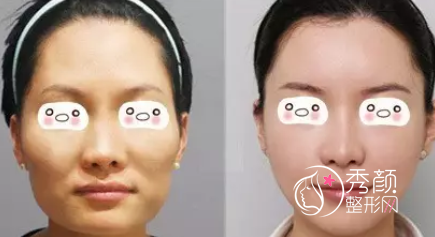 为什么越来越多明星、网红都在做面部脂肪填充?