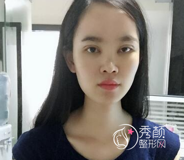 长春铭医整形医院做鼻部手术多少钱?附铭医鼻部整形价格表及隆鼻案例。