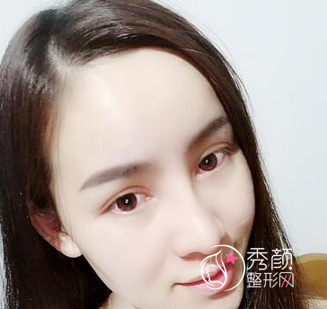 长春铭医整形医院做鼻部手术多少钱?附铭医鼻部整形价格表及隆鼻案例。