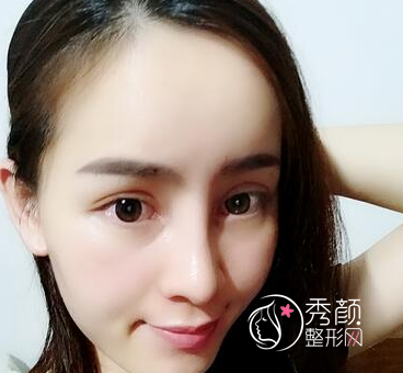 长春铭医整形医院做鼻部手术多少钱?附铭医鼻部整形价格表及隆鼻案例。