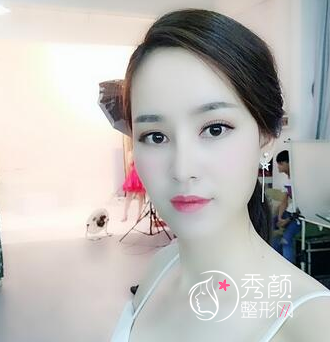 长春铭医整形医院做鼻部手术多少钱?附铭医鼻部整形价格表及隆鼻案例。