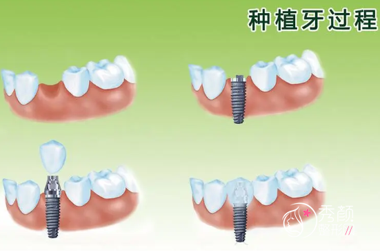 种植牙齿什么品牌比较好,种植一颗牙齿一般需要多少钱?