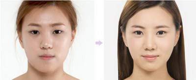 做网红眼双眼皮手术的价格是多少 做网红眼双眼皮手术的价格是多少