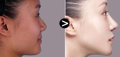 流行的微创除皱手术都有哪些?专家解读 流行的微创除皱手术都有哪些?专家解读