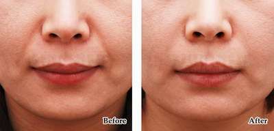 双眼皮手术+去皮去脂 项目分类:眼部整形 双眼皮 切开双眼皮 双眼皮手术+去皮去脂 项目分类:眼部整形 双眼皮 切开双眼皮