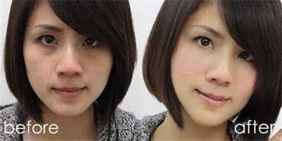 做腰腹吸脂手术,术后效果很理想 做腰腹吸脂手术,术后效果很理想