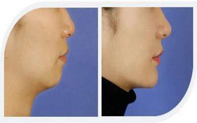 磨腮削骨有哪几种方式 磨腮削骨有哪几种方式