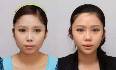 磨腮削骨有哪几种方式 磨腮削骨有哪几种方式