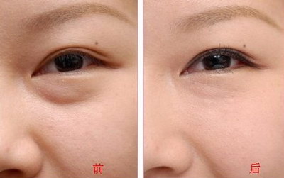 嘉兴双眼皮整形整形医生排名_附整形案例