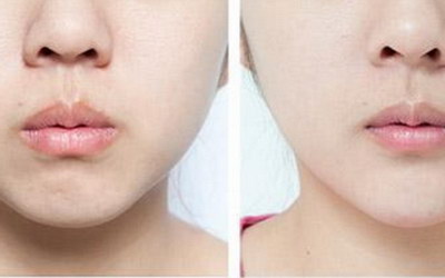 自体脂肪丰太阳穴收费价目表,大约多少钱? 自体脂肪丰太阳穴收费价目表,大约多少钱?