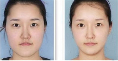 自体脂肪丰太阳穴价格费用,贵不贵?