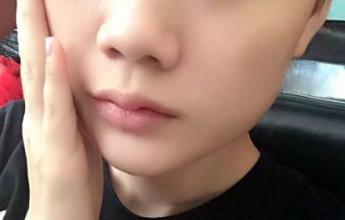 热玛吉除皱术大约要花多少钱?