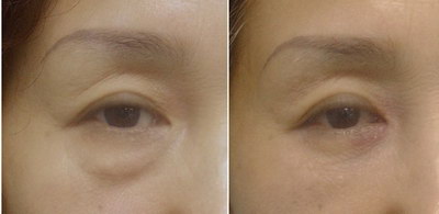 溶脂去眼袋价格一览表_大概多少钱? 溶脂去眼袋价格一览表_大概多少钱?