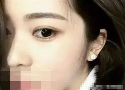 玻尿酸垫眉弓活动优惠价格【如何收费】 玻尿酸垫眉弓活动优惠价格【如何收费】