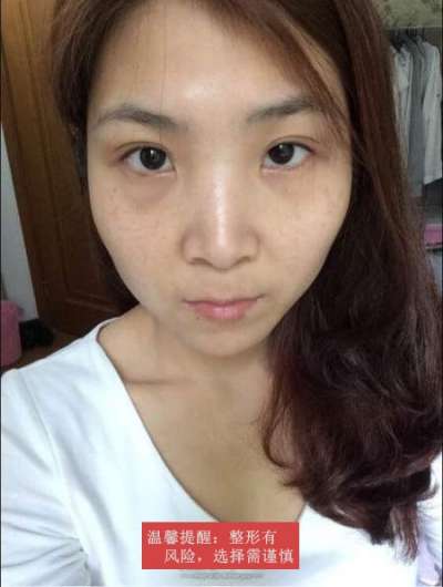 点阵激光后恢复过程图|真实效果全部分享~