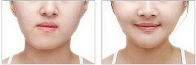 玻尿酸丰卧蚕优惠价格,贵不贵?