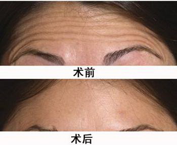 长沙热玛吉整形医生排名分析 长沙热玛吉整形医生排名分析