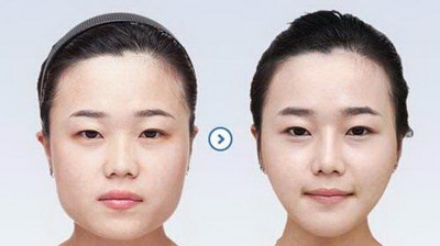 深圳垫太阳穴整形医生口碑排名