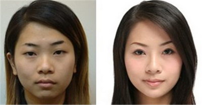 溶脂去眼袋价格表,大概要花多少钱?