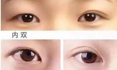 溶脂去眼袋的费用_具体需要多少费用? 溶脂去眼袋的费用_具体需要多少费用?