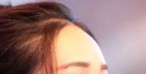 玻尿酸填充卧蚕价格费用,一般需要多少钱? 玻尿酸填充卧蚕价格费用,一般需要多少钱?