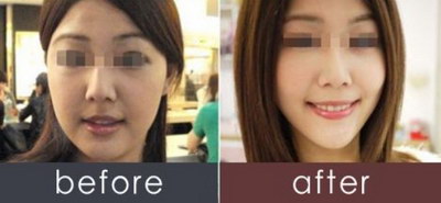 潍坊自体脂肪丰太阳穴整容医生哪个好? 潍坊自体脂肪丰太阳穴整容医生哪个好?