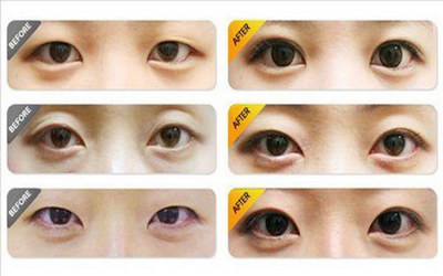 溶脂去眼袋价格费用_大概需要多少钱?