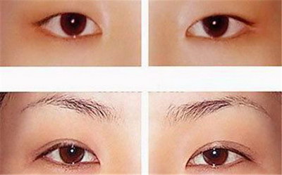 玻尿酸垫眉弓活动优惠价格【如何收费】 玻尿酸垫眉弓活动优惠价格【如何收费】