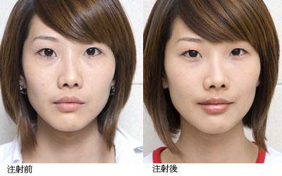 玻尿酸填充卧蚕价格费用,一般需要多少钱?