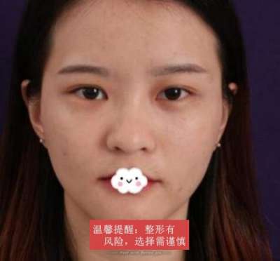 肿眼泡抽脂前后对照图:术后三个月恢复记录~