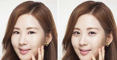 溶脂去眼袋价格表_大概多少钱?