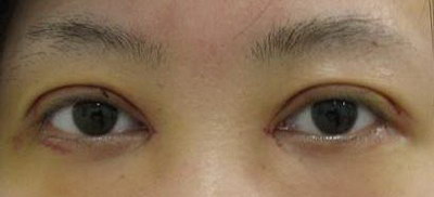 溶脂去眼袋整形费用,大约要花多少钱? 溶脂去眼袋整形费用,大约要花多少钱?