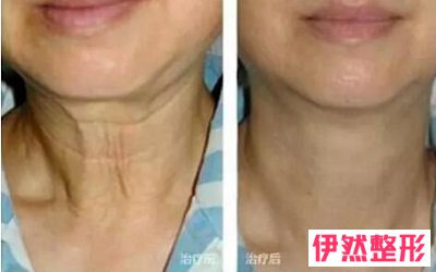 重庆热拉提在哪里有做的?重庆热拉提plus授权医院名单查询