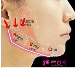 男性过大下颌角整形果好不好?来看手术前后变化:真的值得一做?